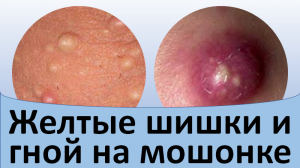 Желтые шишки и гной на мошонке.