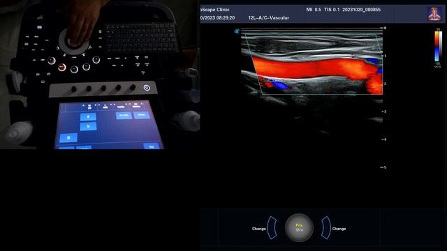 УЗИ сосудов шеи (ЭКДС). Порядок выполнения смотреть онлайн