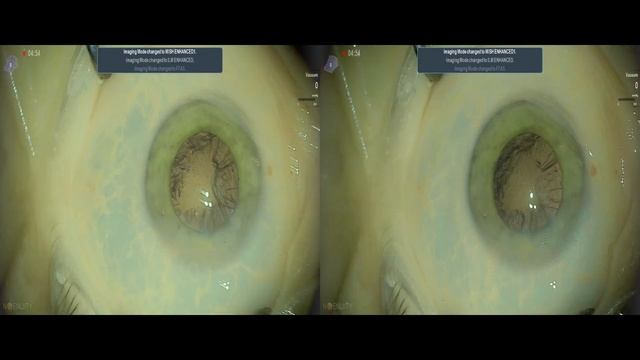 B+L Luxsmart Toric Lukan Mishev live stream смотреть онлайн