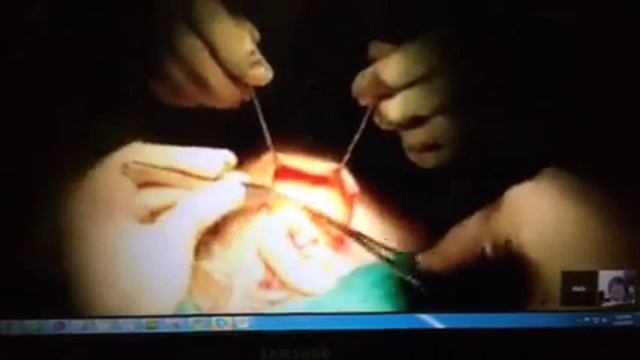 Google Glasses Live Face Lift Surgery with Seattle's Dr. Philip Young with Dr. Rich Castellano смотреть онлайн