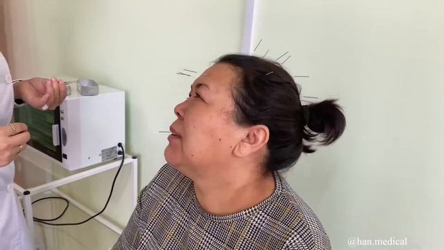 Бет невритін емдеу барысы. Лицевой неврит. Лечение.