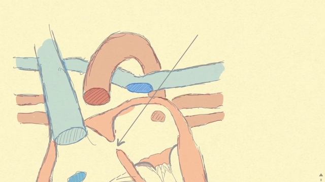 Аномалия Эбштейна (Ebstein). Врожденные пороки сердца.