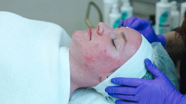 Instructional Video - Professional Jessner's Peel Solution