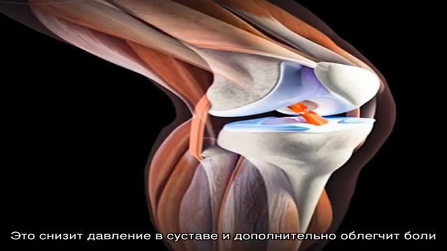 Препателлярный бурсит смотреть онлайн