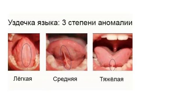 Короткая подъязычная уздечка у ребёнка. Что делать если у ребенка укороченная подъязычная уздечка? смотреть онлайн
