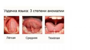 Короткая подъязычная уздечка у ребёнка. Что делать если у ребенка укороченная подъязычная уздечка?