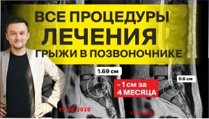 Вся правда о лечении в Клинике Ткачева Епифанова (КТЕ, ТЕМЕД). 2 курса резорбции - какие итоги?
