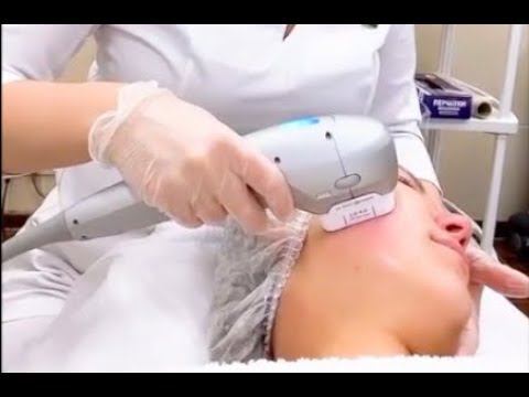 Ультразвуковой SMAS-лифтинг Ультраформер 3 (Ultraformer III) смотреть онлайн