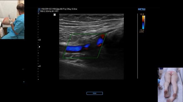 Стандартизованное УЗИ артерий нижних конечностей (профессор Куликов В.П.)