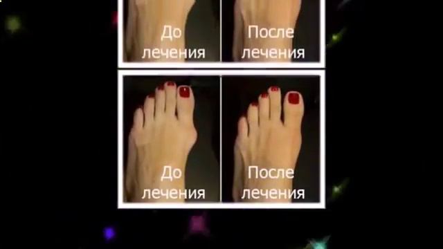 как убрать косточку на ноге смотреть онлайн