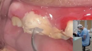 Чистка зубов. Очень большие камни. Я вижу такое впервые. Удаляем зубные отложения