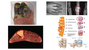 Патологическая анатомия | НЕКРОЗ