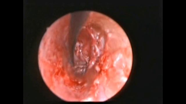 Rzayev R.M. - Перфорация барабанной перепонки - Эндомеатальная эндоскопическая мирингопластика смотреть онлайн