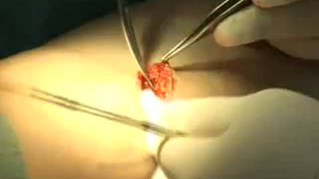 Увеличение голени (круропластика). Пластический хирург С... смотреть онлайн