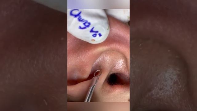 Acne. Blackheads. Ingrown hairs and pimple popping. смотреть онлайн