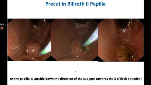 ERCP Billroth II Sphincterotomy Clip смотреть онлайн