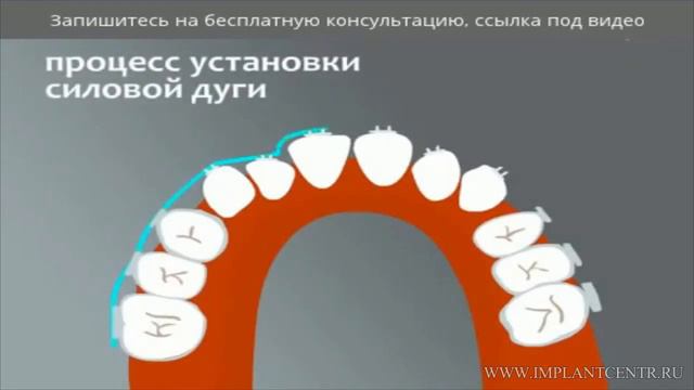 Исправление прикуса зубов брекетами смотреть онлайн