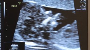 Как правильно оценить носовую кость плода при скрининге в 11-13 недель беременности