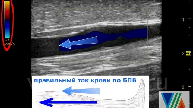 Несостоятельность клапана БПВ смотреть онлайн