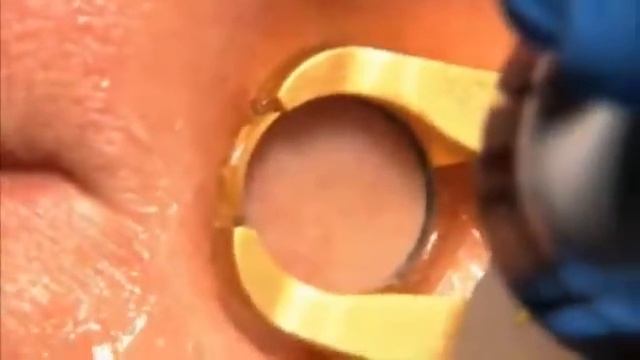 ▶ Cutera Excel V Vascular Laser смотреть онлайн