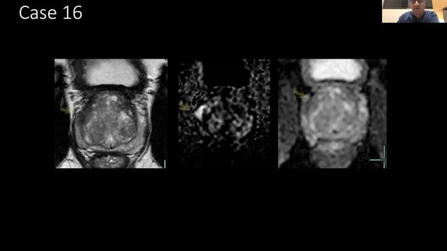 “Prostate MRI: PI-RADS and beyond”. Dr Sairam T. University of Texas Health Science Center , Texas смотреть онлайн