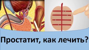 Простатит как лечить. Простатит лечение.