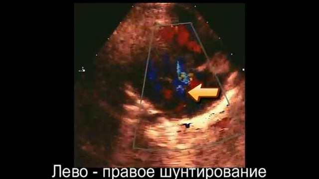 Дефект межпредсердной перегородки у детей. Дефекты типа ostium secundum и ostium primum смотреть онлайн