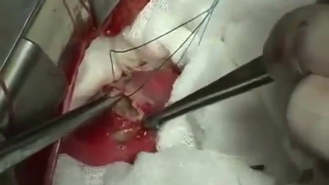 Паразиты Эхинококк в сердце смотреть онлайн