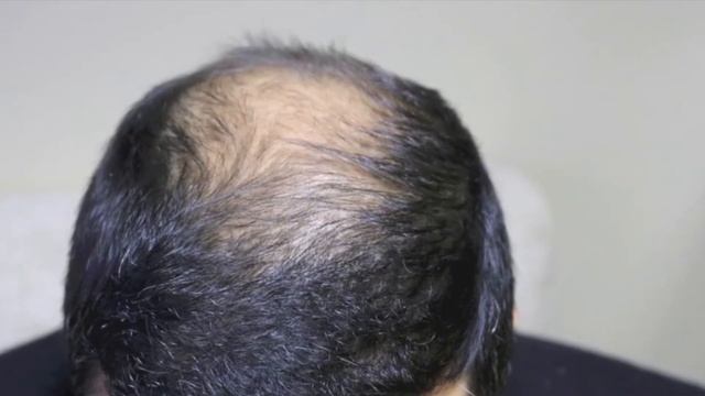 До и после пересадки волос в Турции 3100 графтов | Отзыв на пересадку волос в Турции Fue методом смотреть онлайн