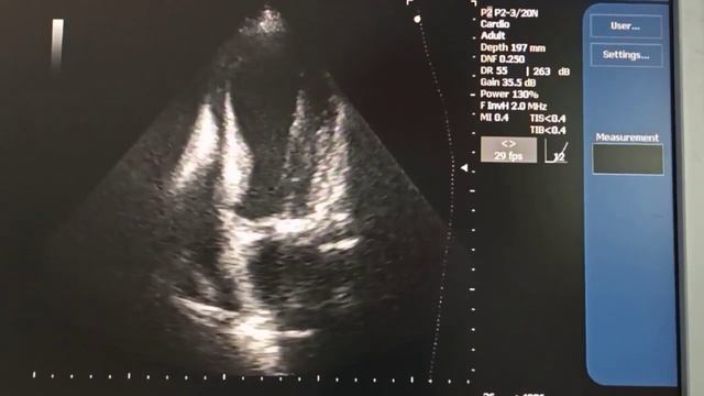 Аневризма левого желудочка с эффектом спонтанного контрастирования и выпотом в перикарде смотреть онлайн