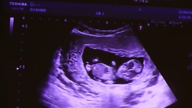 Узи ребенка.11-12 недель .Мальчик.
