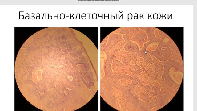 Базально клеточный рак кожи смотреть онлайн