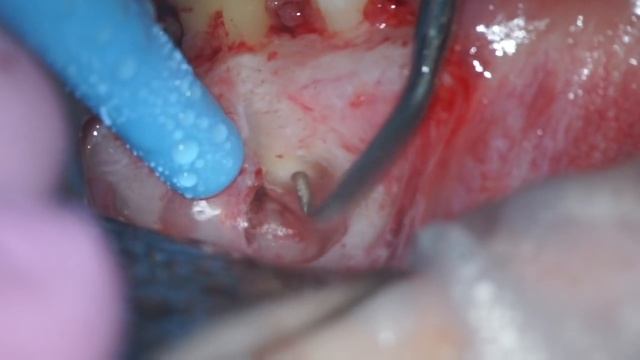 apical surgery 2.6 смотреть онлайн