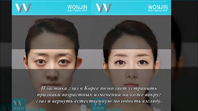 Пластика глаз в Корее смотреть онлайн