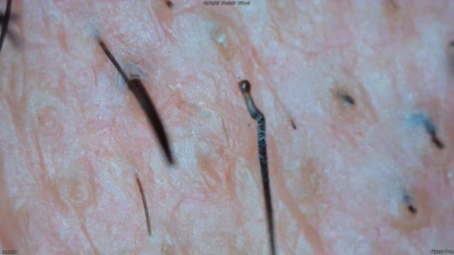 0343 pull out hair Around the nose and lips смотреть онлайн