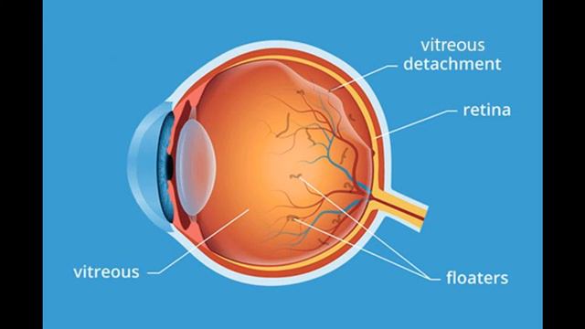 Eye Floaters - When Should You Consult A Doctor? | Eye Floaters Treatment