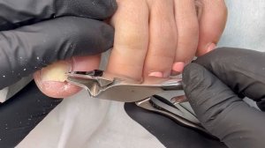 ?Онихолизис | Подногтевой мозоль | Врастания ногтя | Деформация формы |