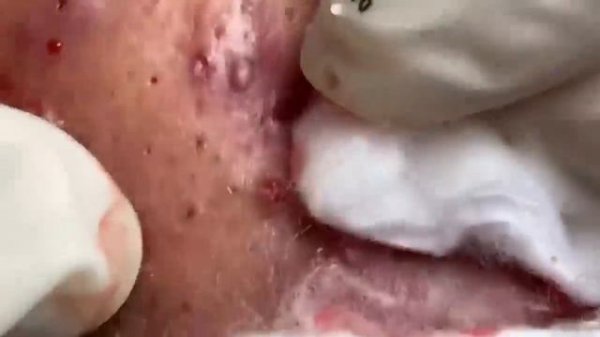 relaxing blackheads removal pimple popping videos blackheads removal large blackheads popping