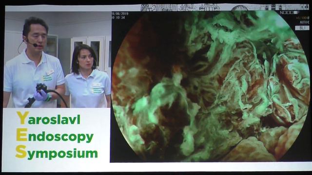 04Live Yutaka Saito 0 Ip adenoma кишки HGD EndoLoop resection удаление смотреть онлайн