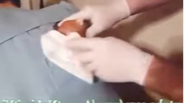 BEST Cyst Popping Compilation 2016 #2 New Zits, Pimples Extr   YouTube