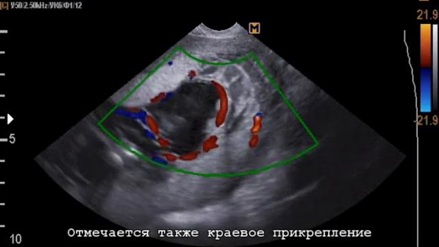 Vasa previa (type 2) succenturiate lobe (20-2-18) УЗИ предлежание сосудов смотреть онлайн