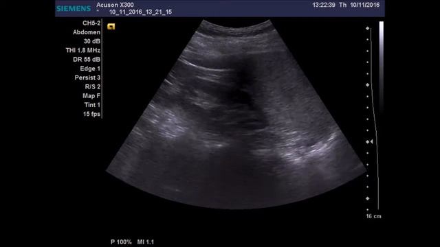 Липома правого надпочечника смотреть онлайн