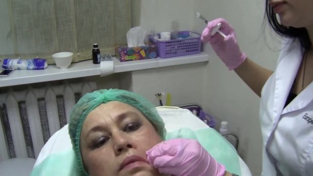 Как убрать носогубные складки с помощью филлеров? смотреть онлайн