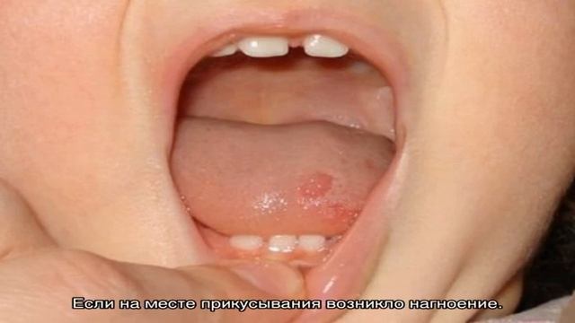 Что делать, если ребенок прикусил язык до крови? смотреть онлайн