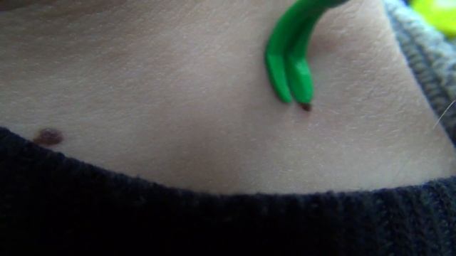 Как ВЫТАЩИТЬ маленького Клеща? How to remove a little tick? смотреть онлайн