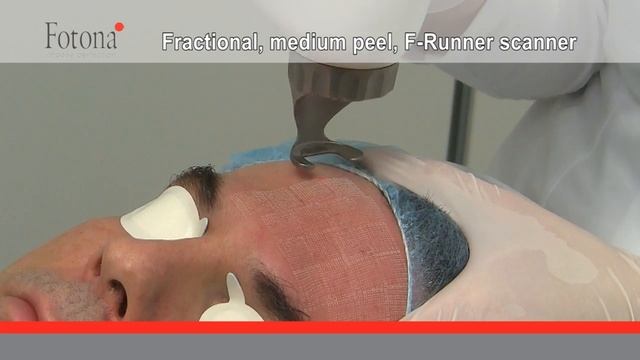 Medium Peel With Fotona's Fractional Er:YAG Scanner F-Runner