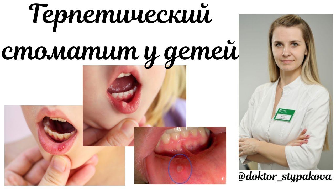 Герпетический стоматит у детей.Диагностика.Лечение. смотреть онлайн