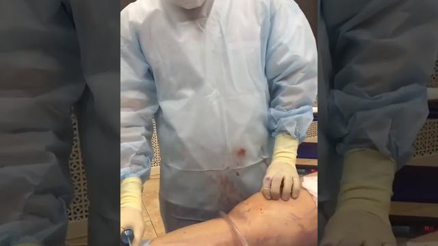 Липосакция коленей смотреть онлайн