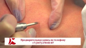 Удаление папиллом