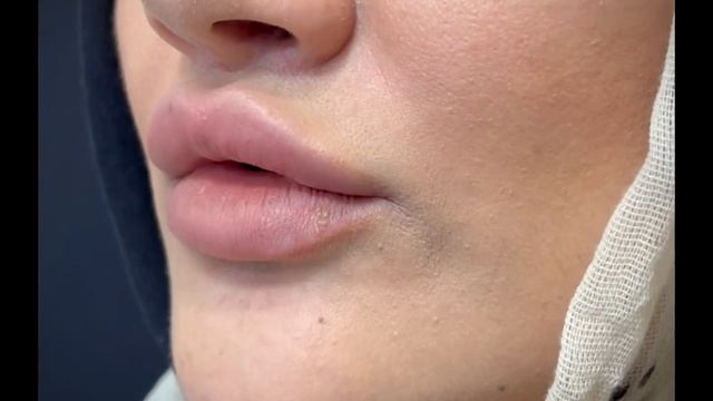 ПУХЛЫЕ ГУБЫ БЕЗ УКОЛОВ? смотреть онлайн